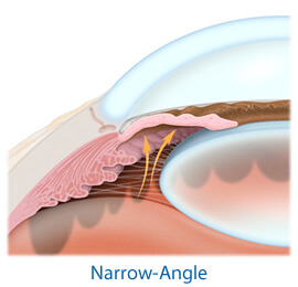 Narrow-Angle