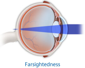 Farsightedness