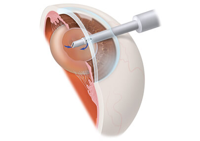 aao-a22