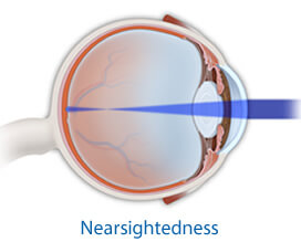 Nearsightedness